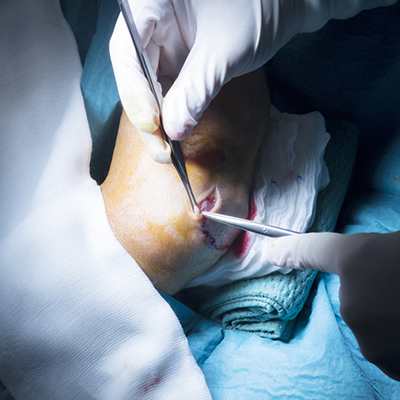 Elbow Arthroscopy in Guntur