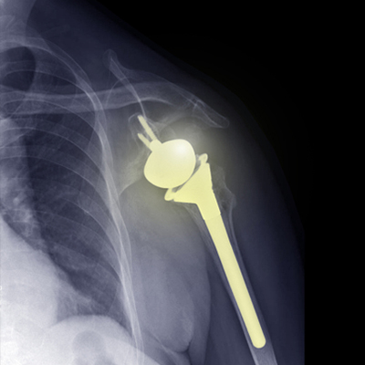 Shoulder Replacement Surgery in Guntur